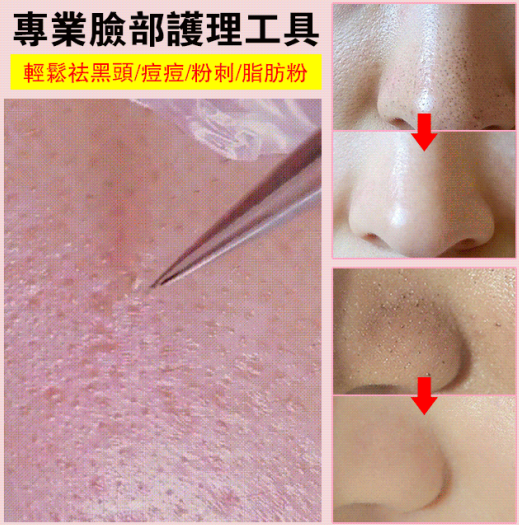 不銹鋼粉刺黑頭夾火爆熱銷中！官方正品，免費試用，台灣出貨！24小時在線客服，不好用直接退！售後無憂！